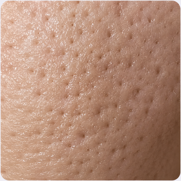 ENLARGED PORES & LOSS OF ELASTICITY